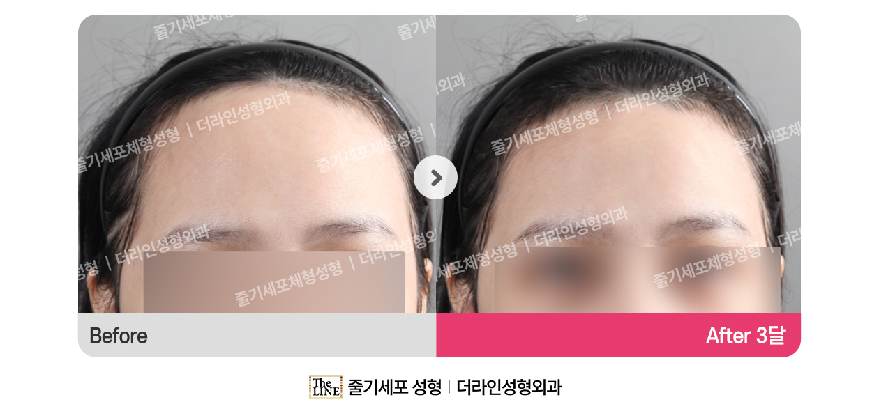 더라인성형외과 시술 상세 이미지