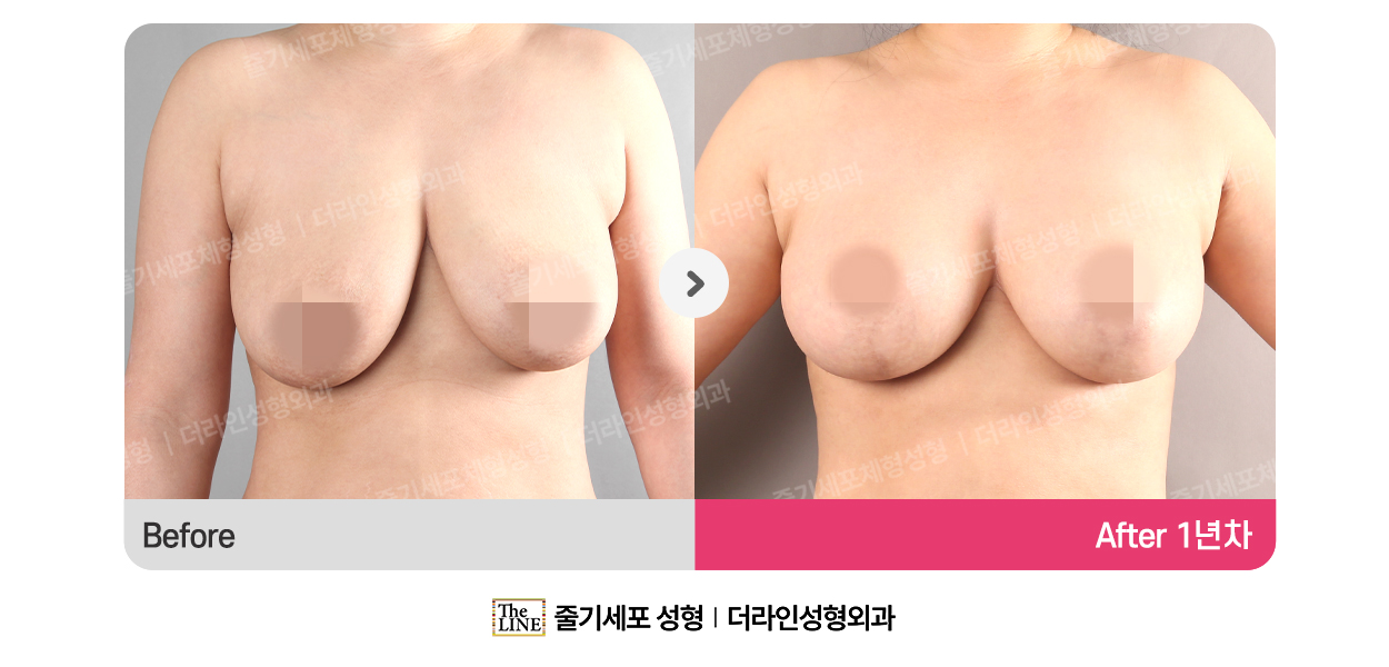 더라인성형외과 시술 상세 이미지