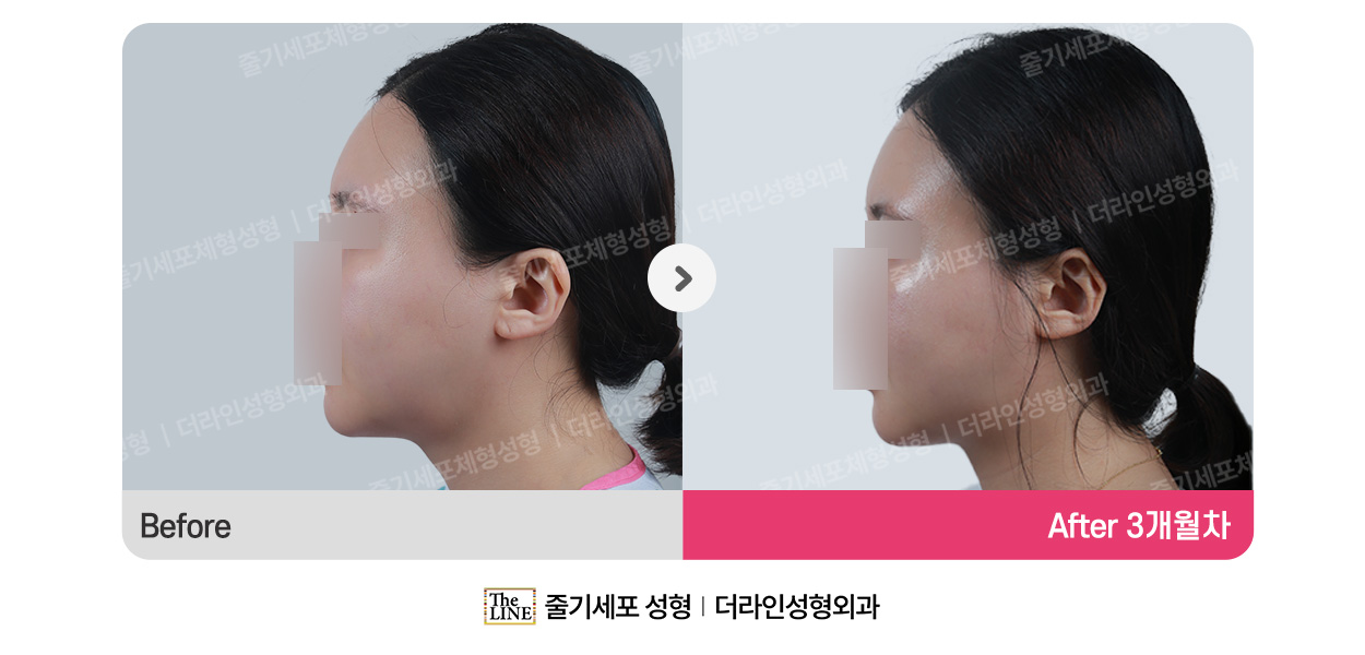 더라인성형외과 시술 상세 이미지