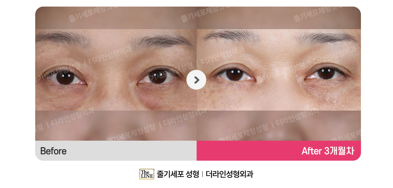 더라인성형외과 시술 상세 이미지