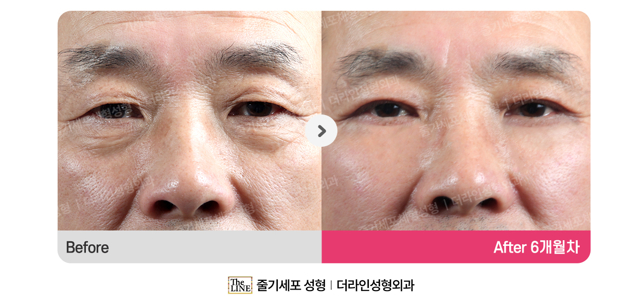 더라인성형외과 시술 상세 이미지