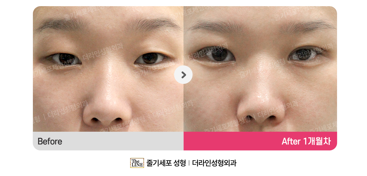 눈성형 (통합) 대표 이미지
