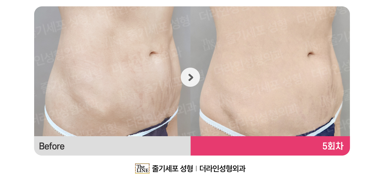 더라인성형외과 시술 상세 이미지