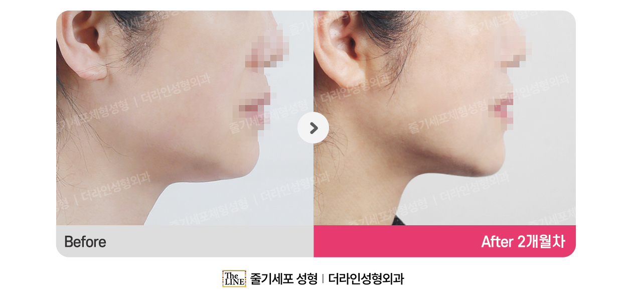 더라인성형외과 시술 상세 이미지