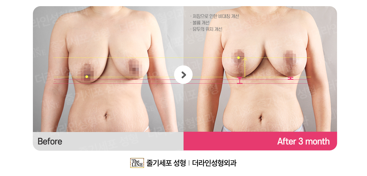 더라인성형외과 시술 상세 이미지