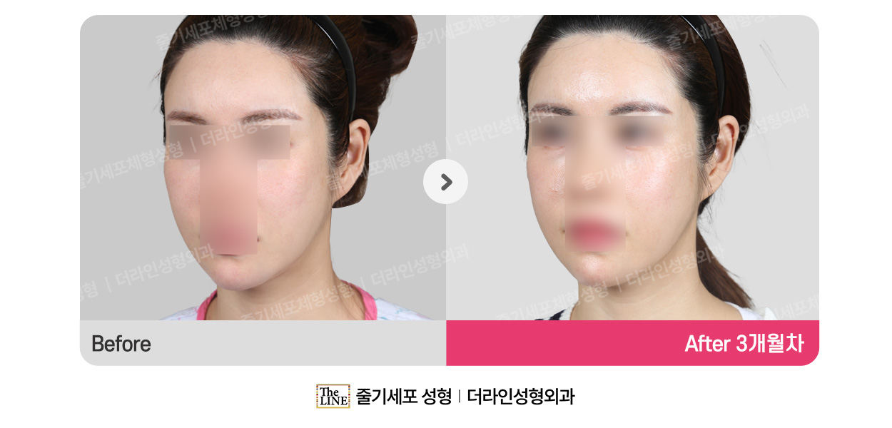 더라인성형외과 시술 상세 이미지