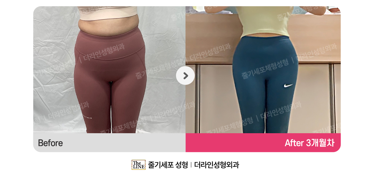 더라인성형외과 시술 상세 이미지