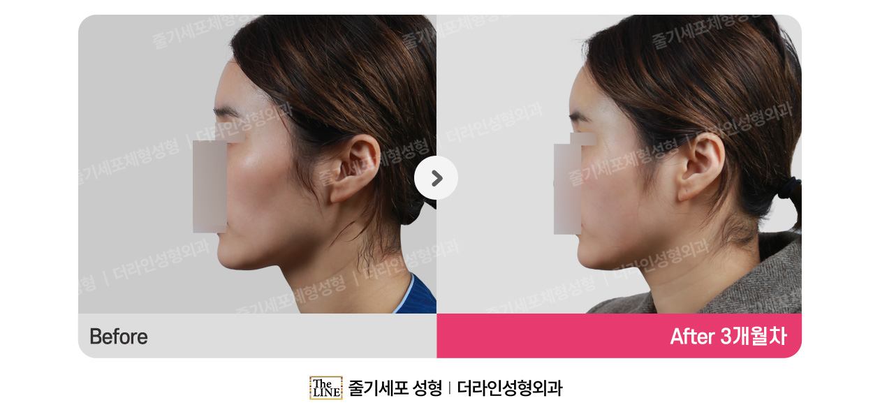 더라인성형외과 시술 상세 이미지