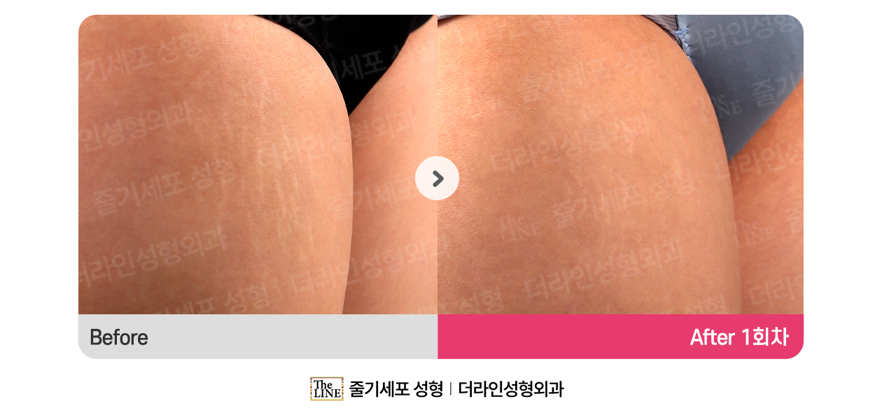 더라인성형외과 시술 상세 이미지