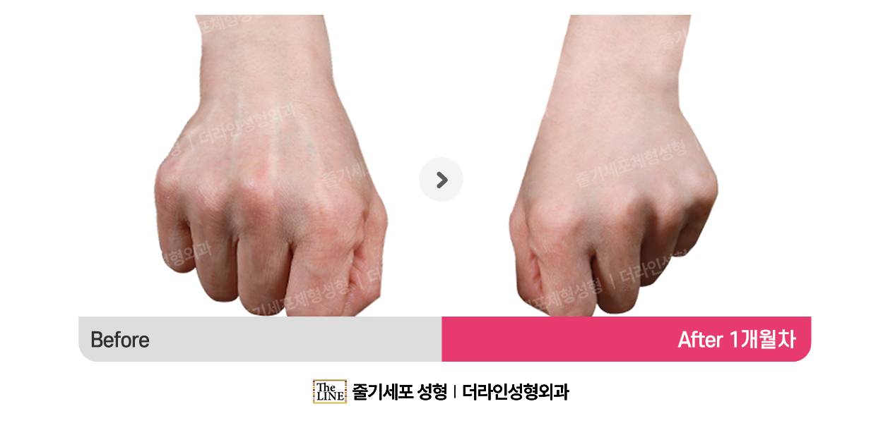 더라인성형외과 시술 상세 이미지