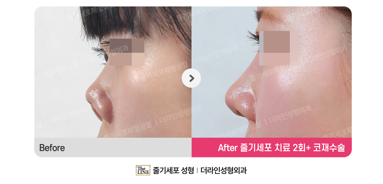 더라인성형외과 시술 상세 이미지