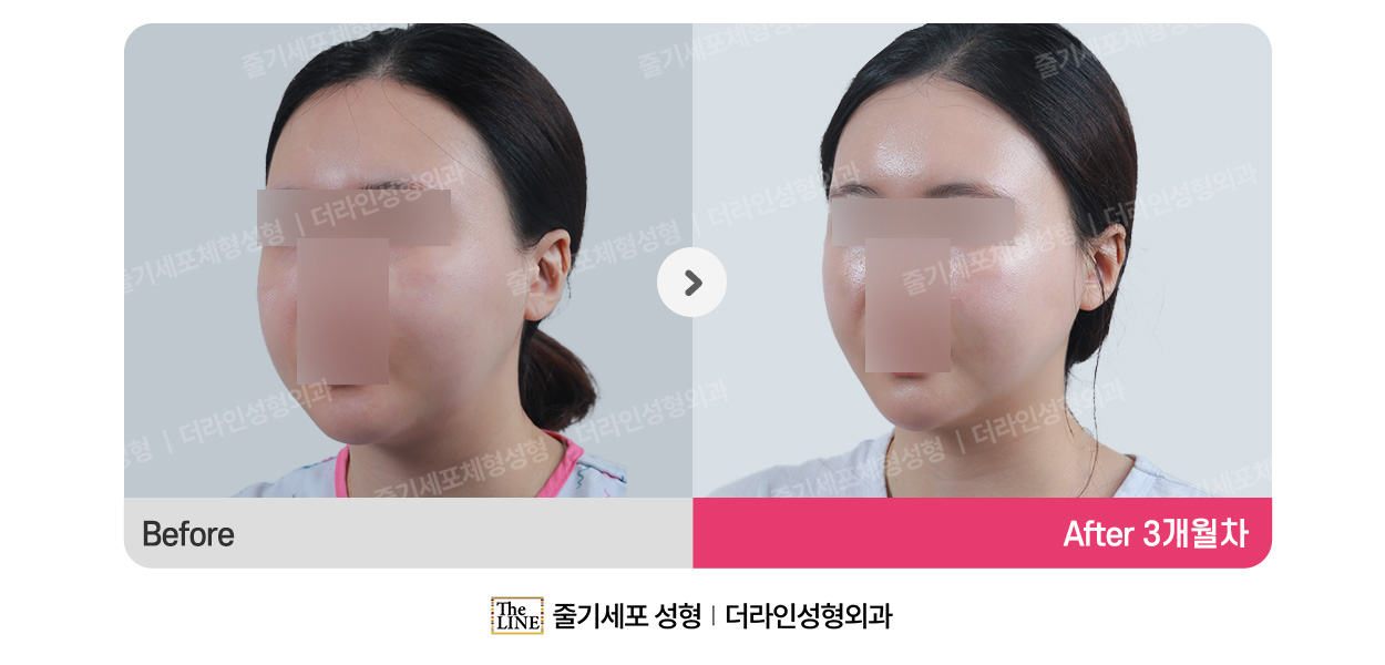 더라인성형외과 시술 상세 이미지