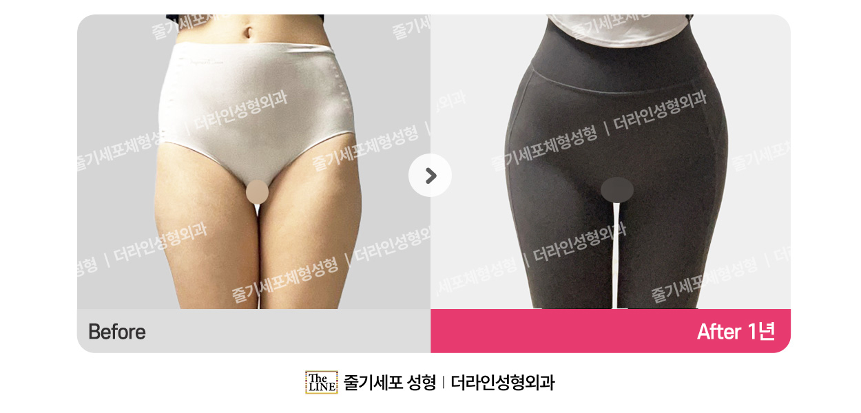더라인성형외과 시술 상세 이미지