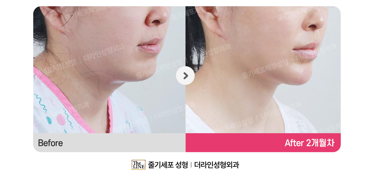 더라인성형외과 시술 상세 이미지