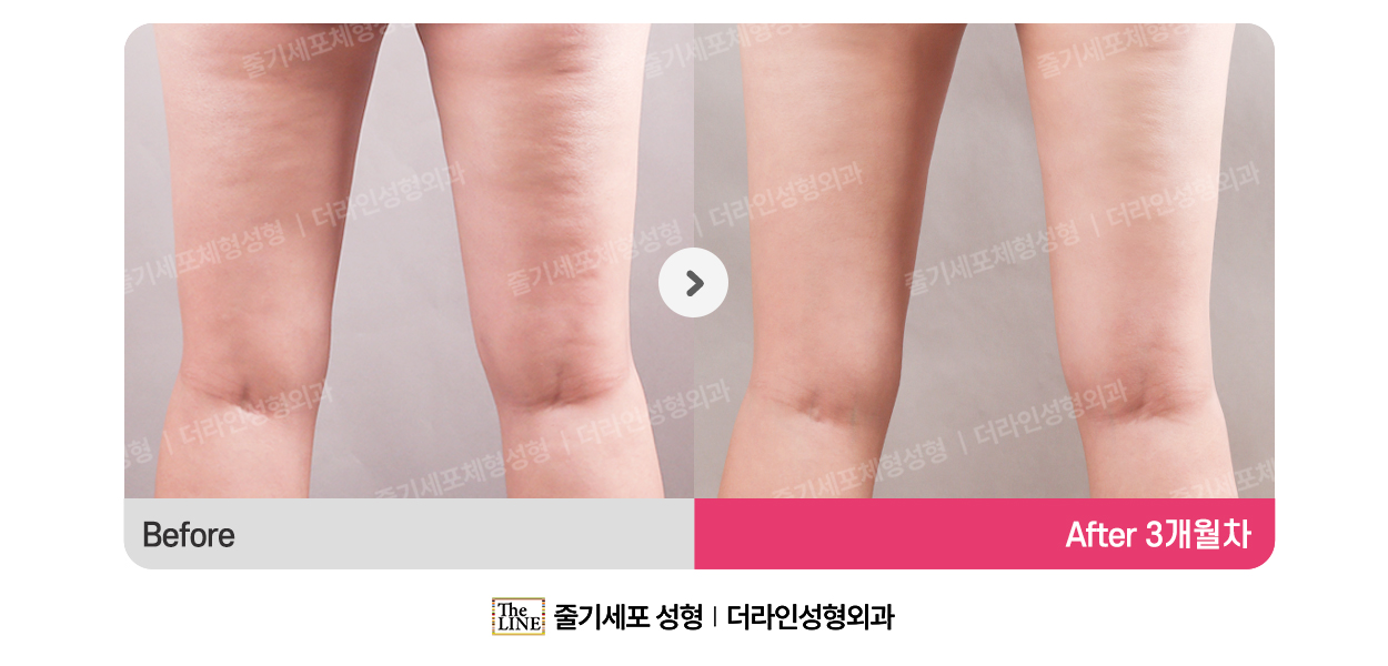 더라인성형외과 시술 상세 이미지