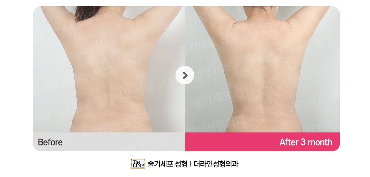 더라인성형외과 시술 상세 이미지