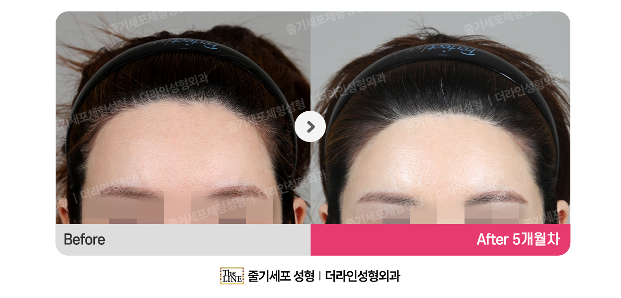더라인성형외과 시술 상세 이미지