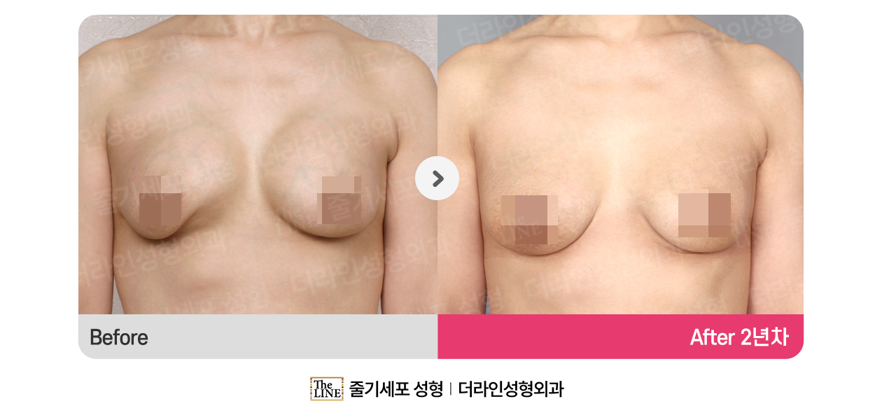 더라인성형외과 시술 상세 이미지