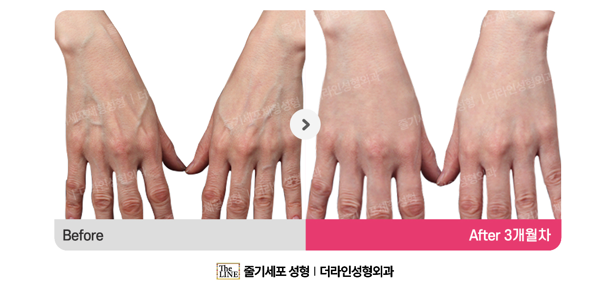 더라인성형외과 시술 상세 이미지