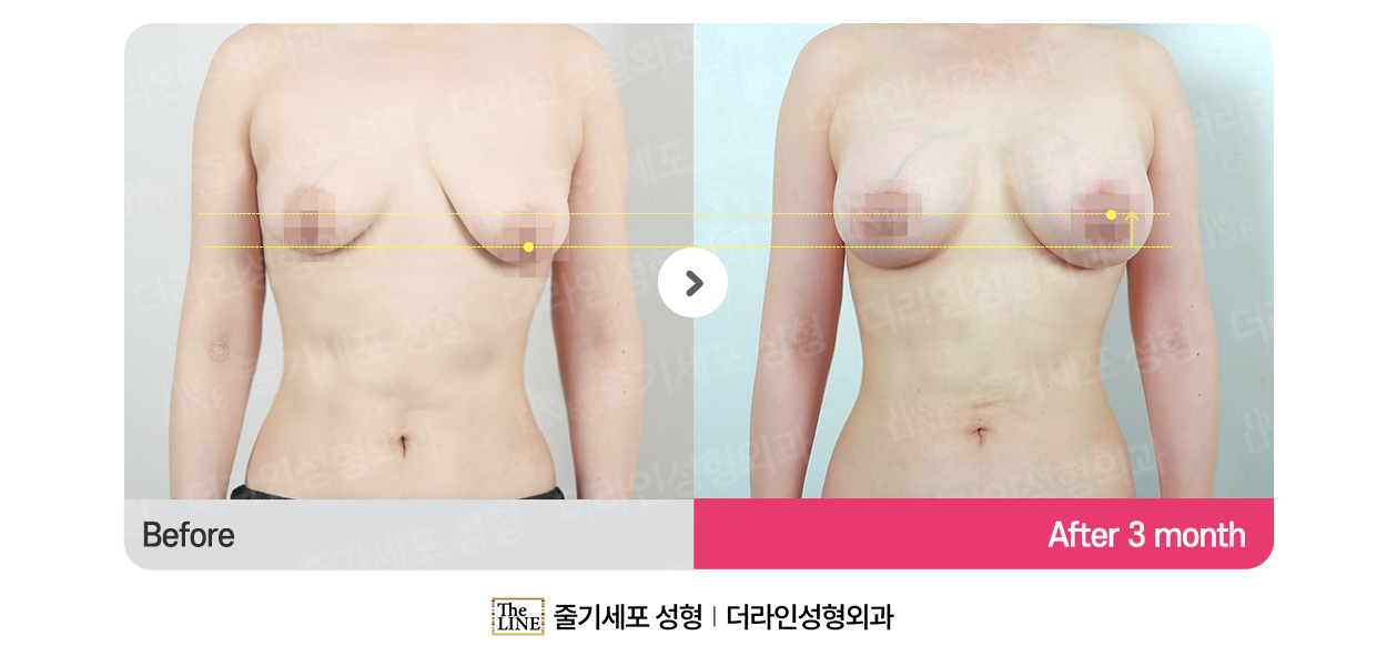 더라인성형외과 시술 상세 이미지