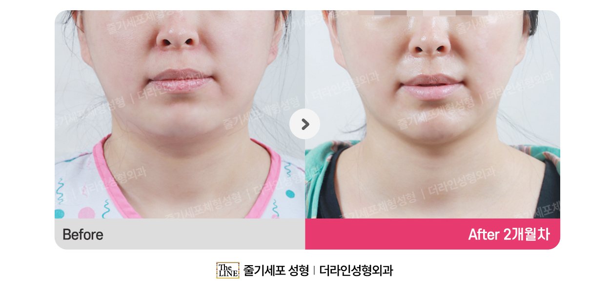더라인성형외과 시술 상세 이미지
