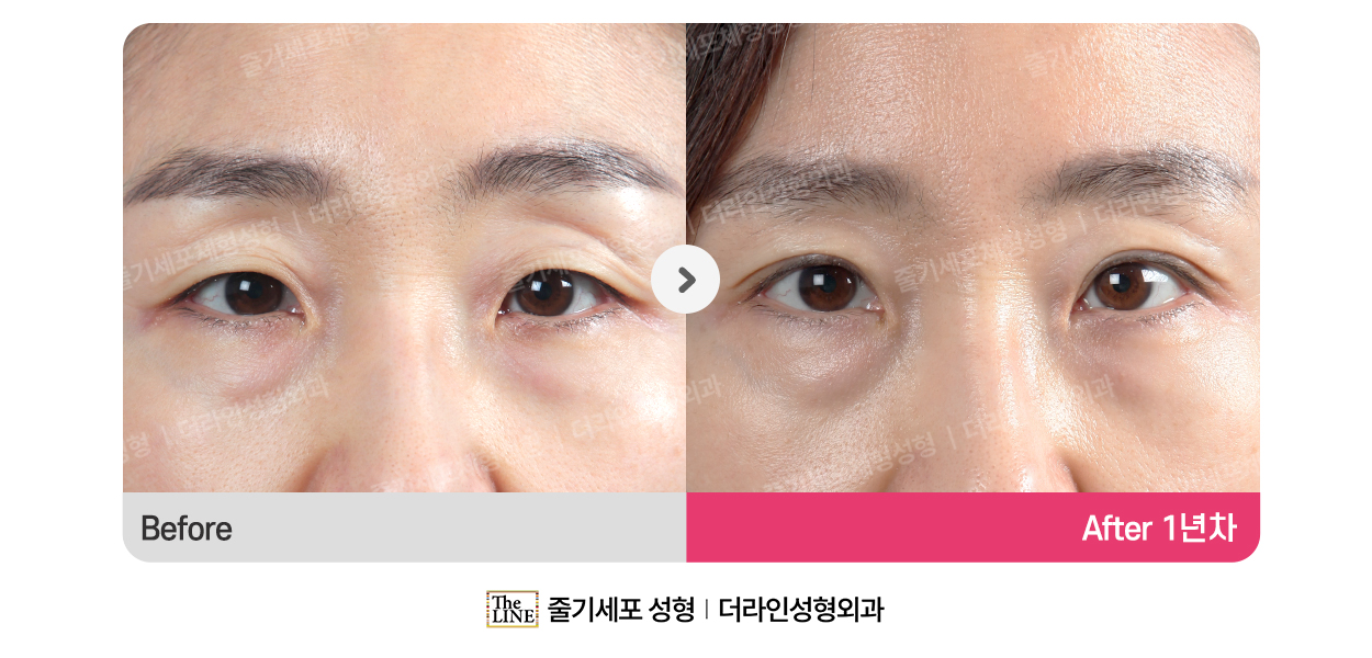 더라인성형외과 시술 상세 이미지