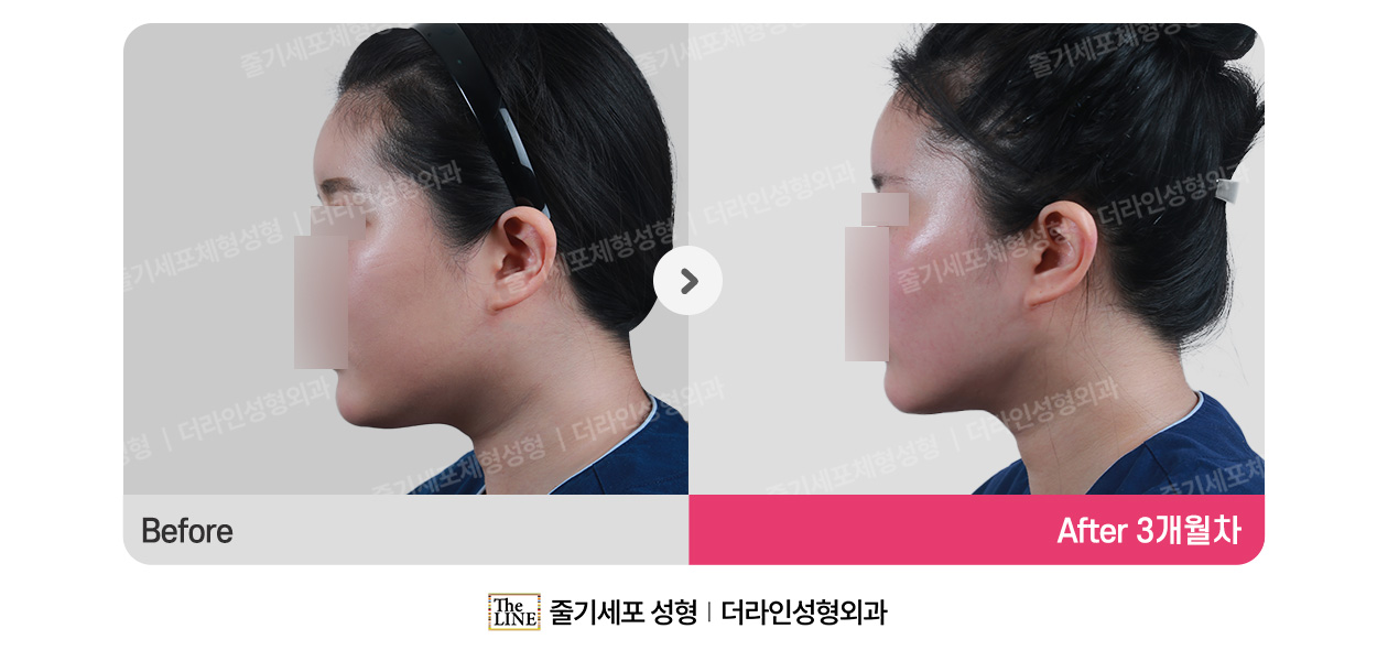 더라인성형외과 시술 상세 이미지