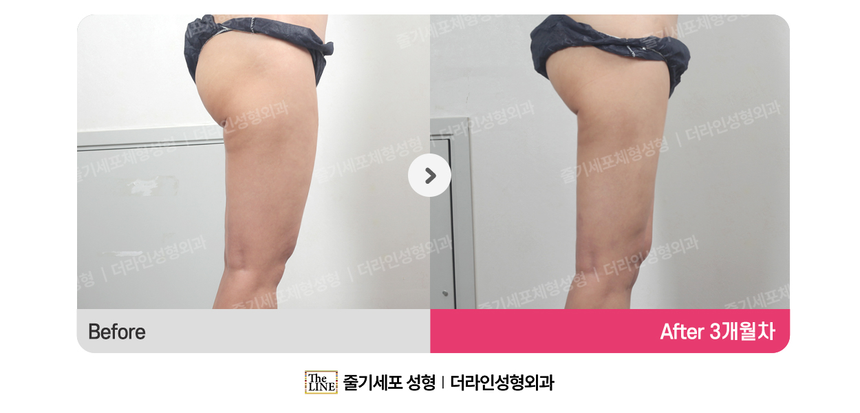 더라인성형외과 시술 상세 이미지