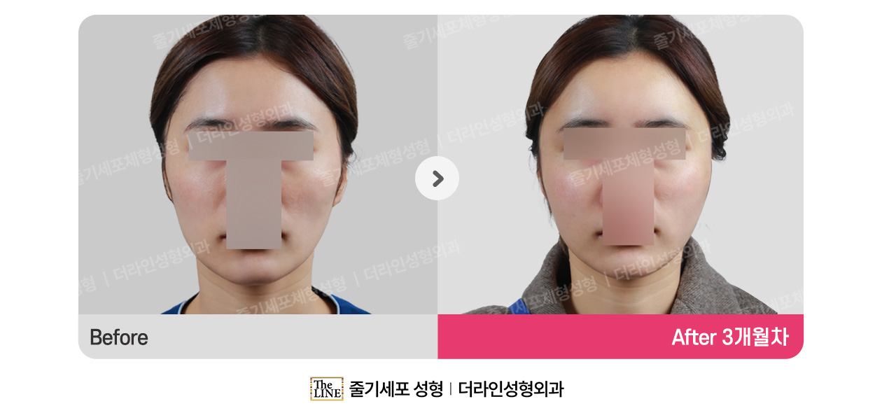 부위별 지방이식 (통합) 대표 이미지