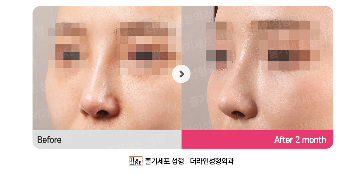 더라인성형외과 시술 상세 이미지