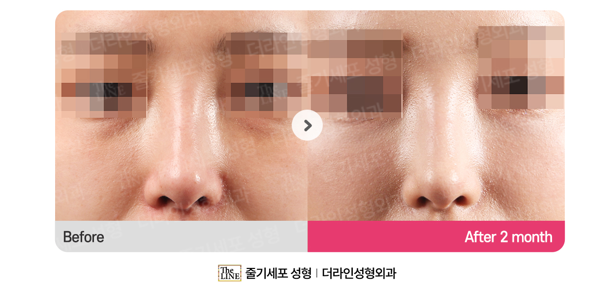 더라인성형외과 시술 상세 이미지