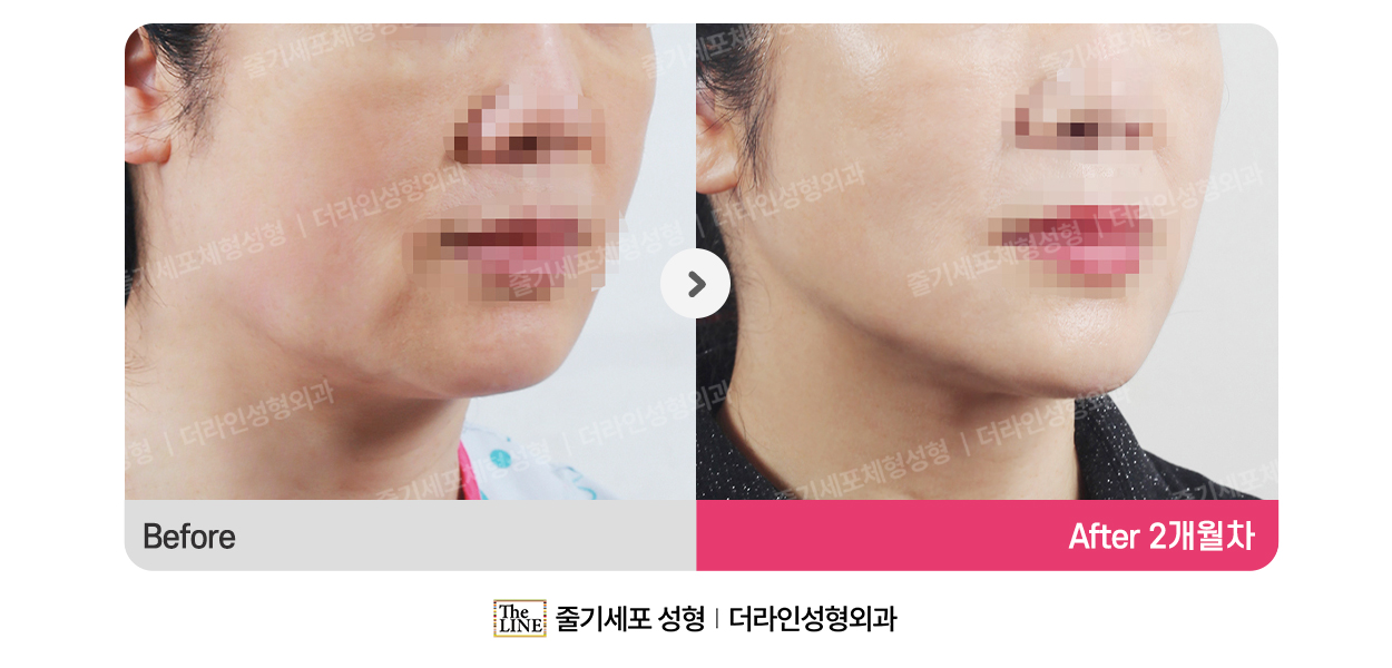 더라인성형외과 시술 상세 이미지
