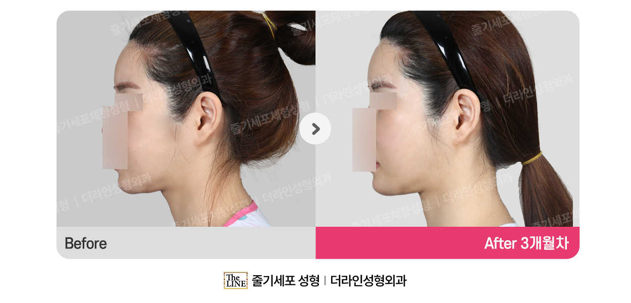 더라인성형외과 시술 상세 이미지