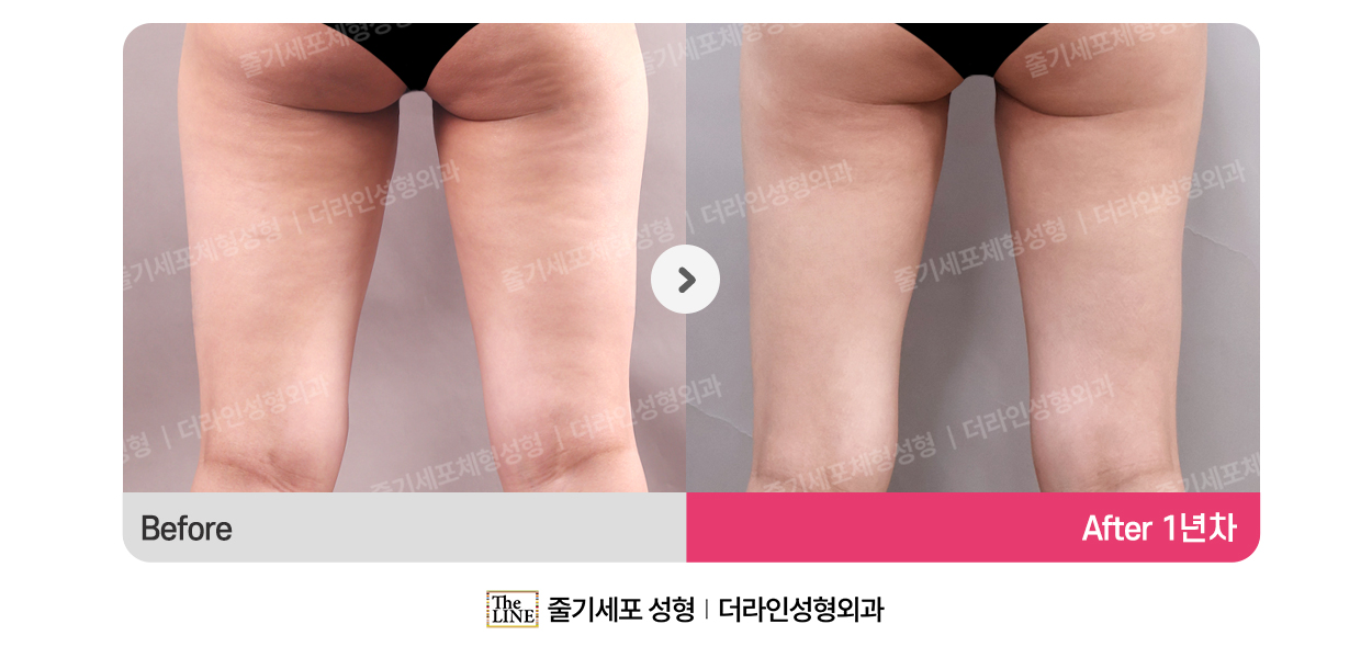 더라인성형외과 시술 상세 이미지