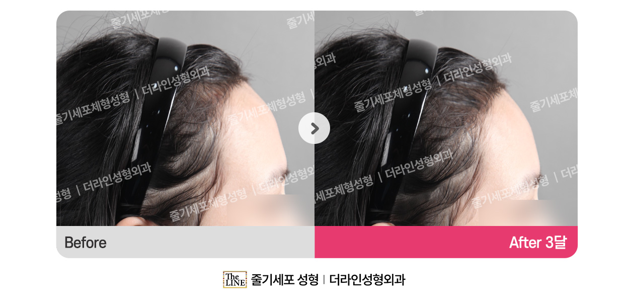 더라인성형외과 시술 상세 이미지