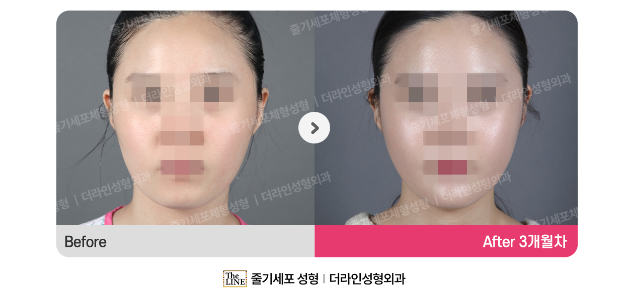 더라인성형외과 시술 상세 이미지