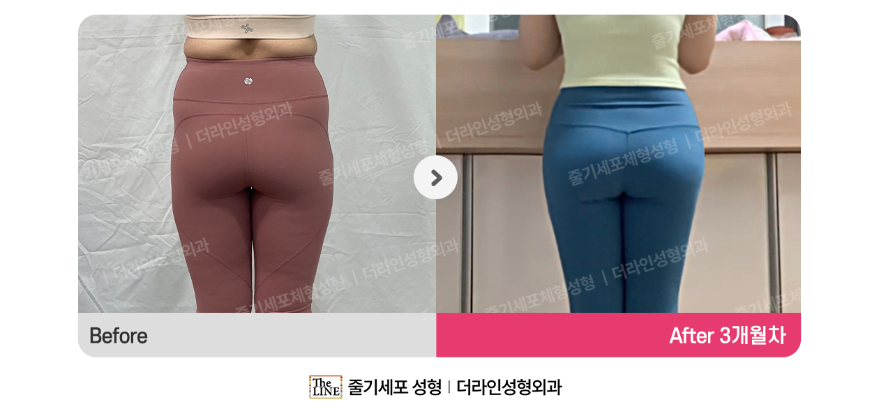 더라인성형외과 시술 상세 이미지