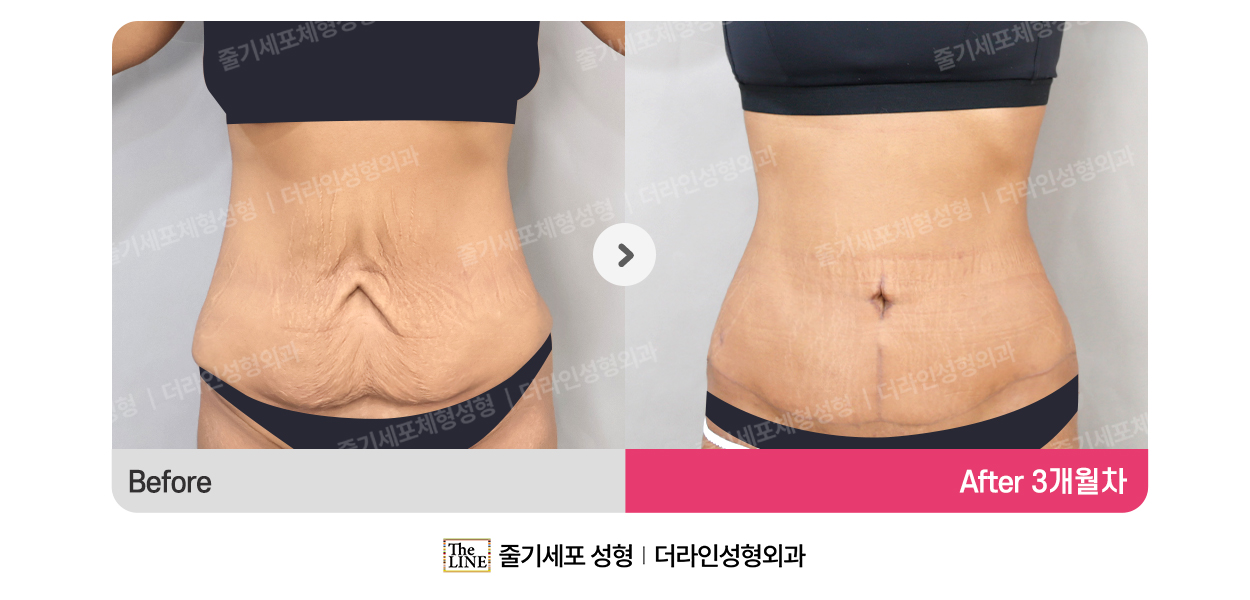 더라인성형외과 시술 상세 이미지