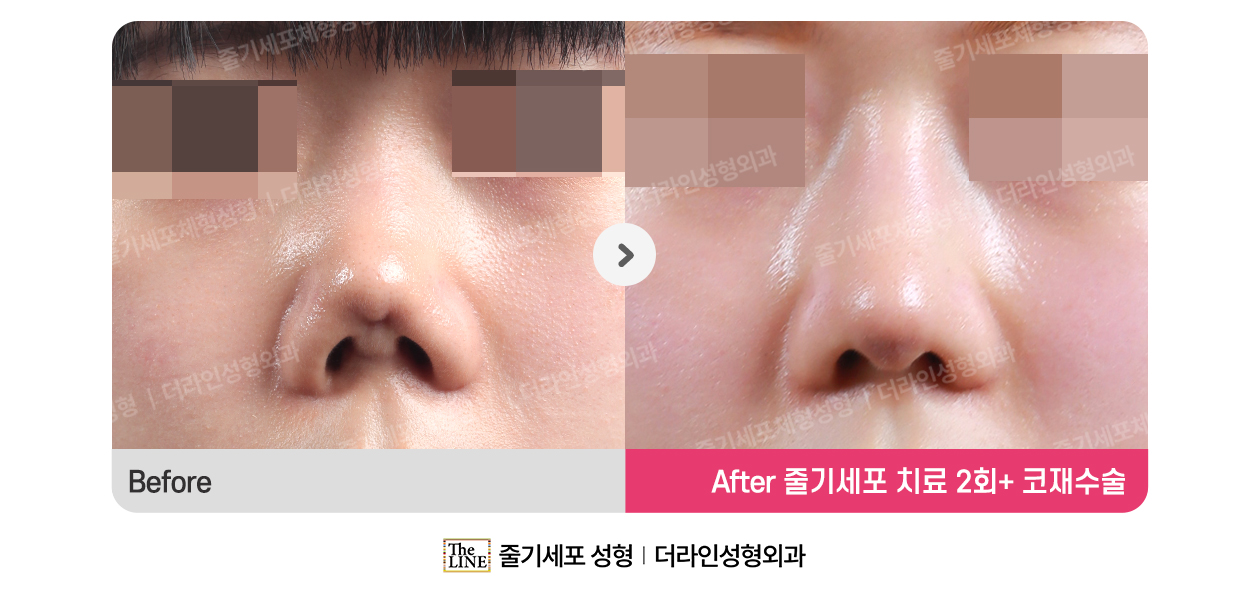 더라인성형외과 시술 상세 이미지