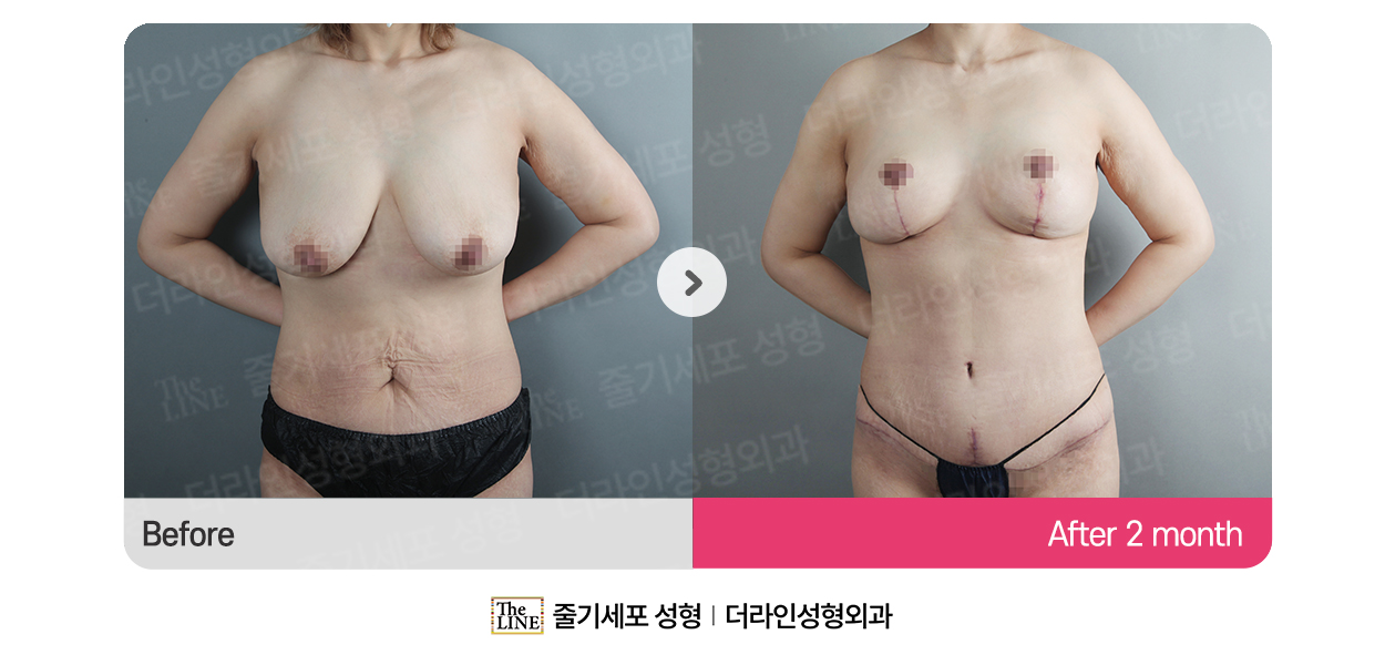더라인성형외과 시술 상세 이미지