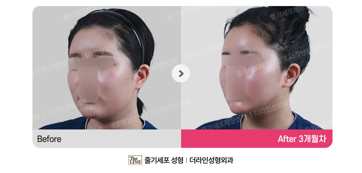 더라인성형외과 시술 상세 이미지