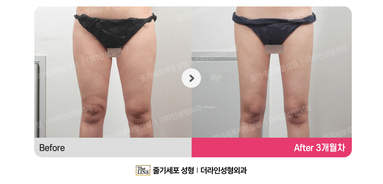 더라인성형외과 시술 상세 이미지