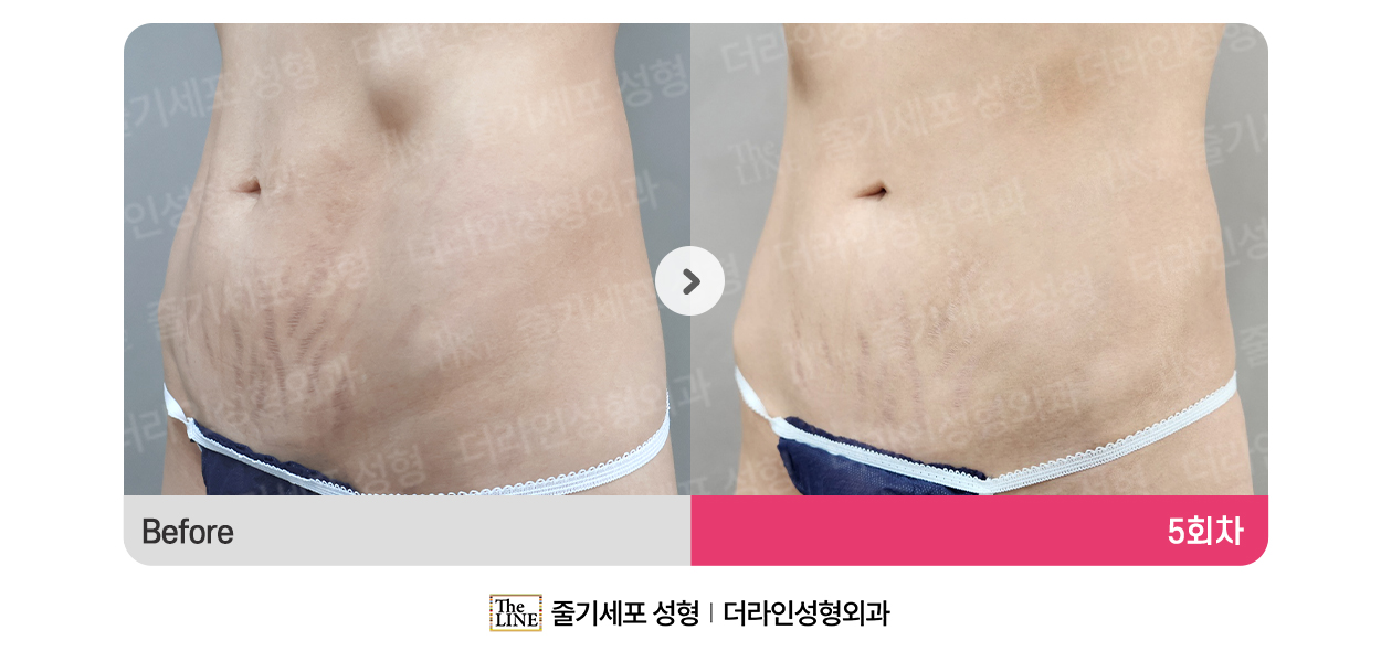 더라인성형외과 시술 상세 이미지