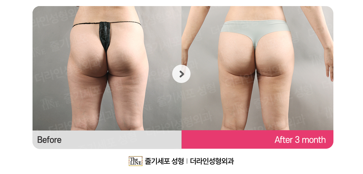 더라인성형외과 시술 상세 이미지