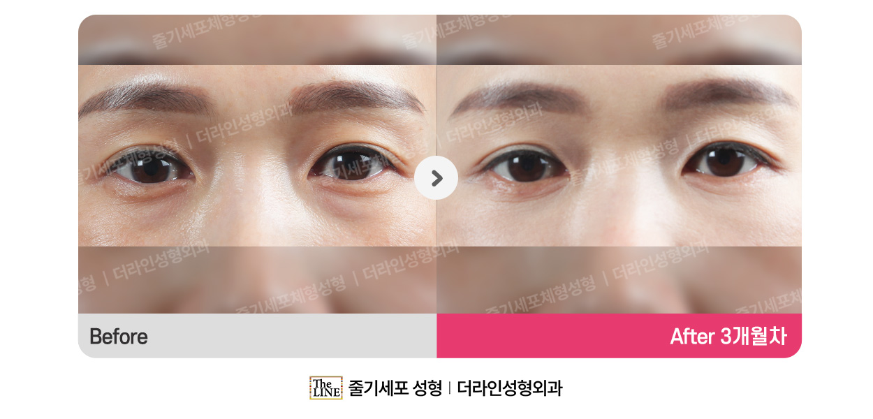 더라인성형외과 시술 상세 이미지