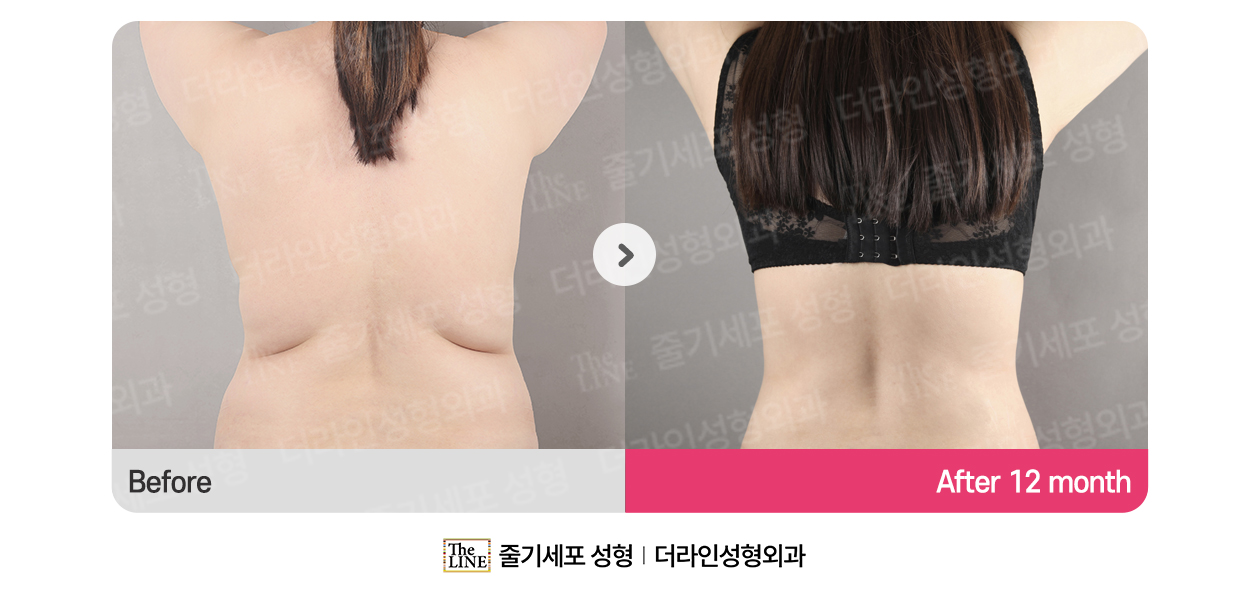 더라인성형외과 시술 상세 이미지