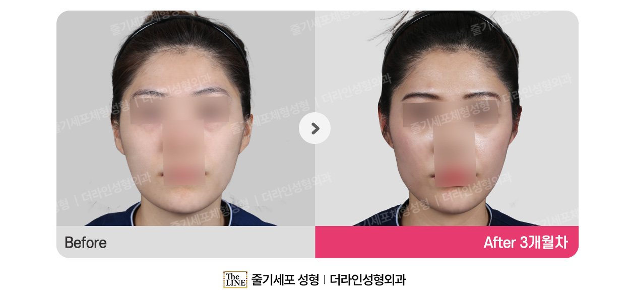 더라인성형외과 시술 상세 이미지