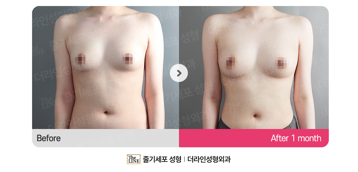 더라인성형외과 시술 상세 이미지