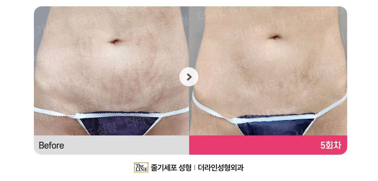 더라인성형외과 시술 상세 이미지
