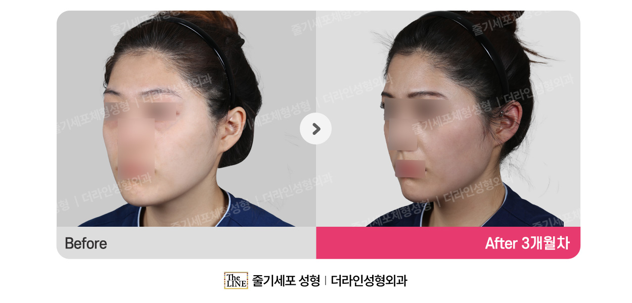 더라인성형외과 시술 상세 이미지